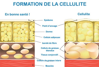 Quel effet des bas de contention sur la cellulite ? - Cellublue